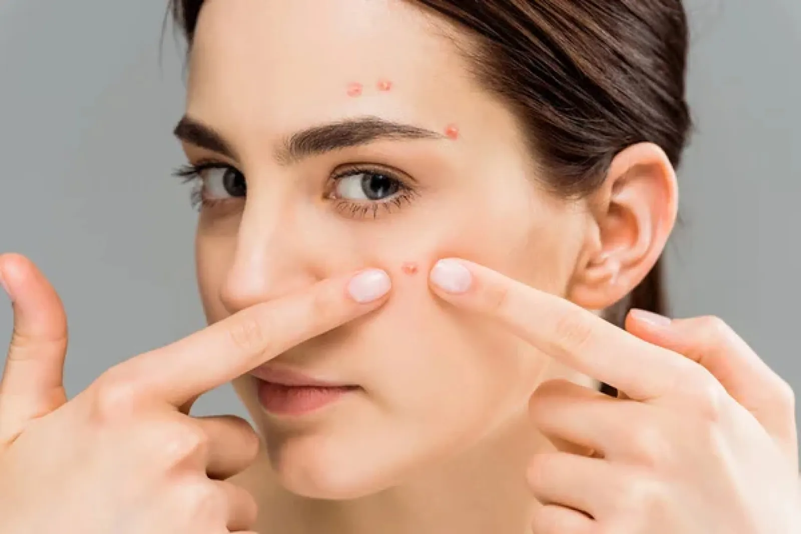 Got a pimple before wedding?  Some easy tips for these breakouts