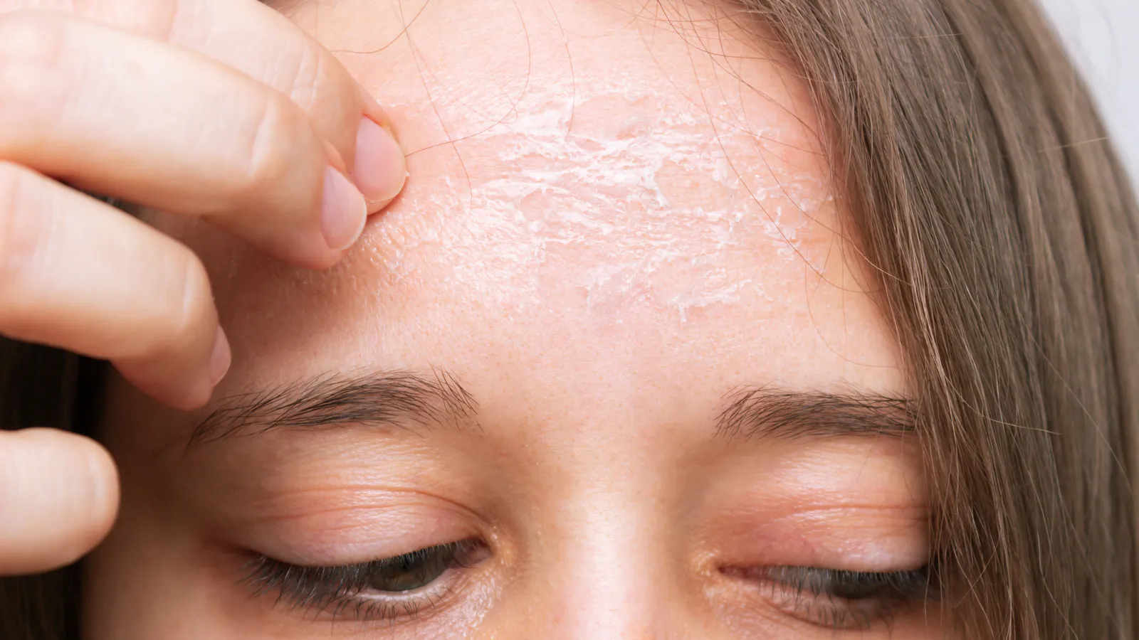 Use these healthy tips to get rid of dryness on forehead